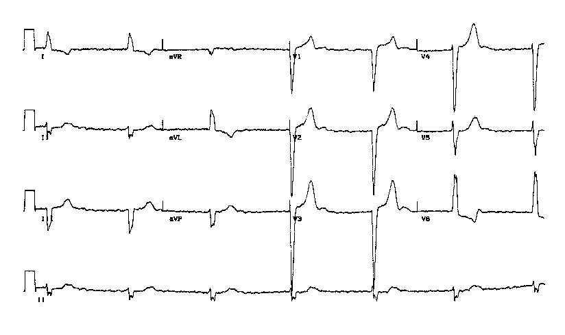 complete heart block