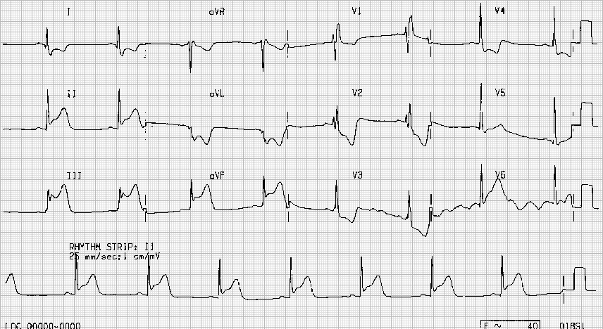 Inferior myocardial infarction