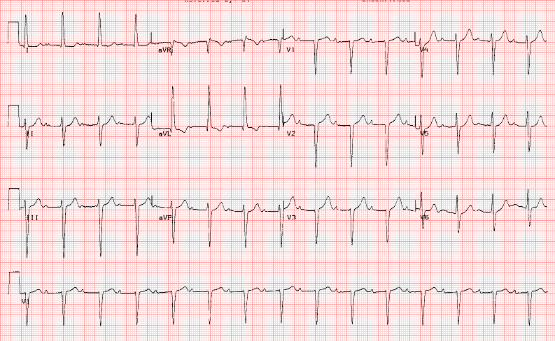 Left anterior hemiblock, LVH, LAH, and long PR