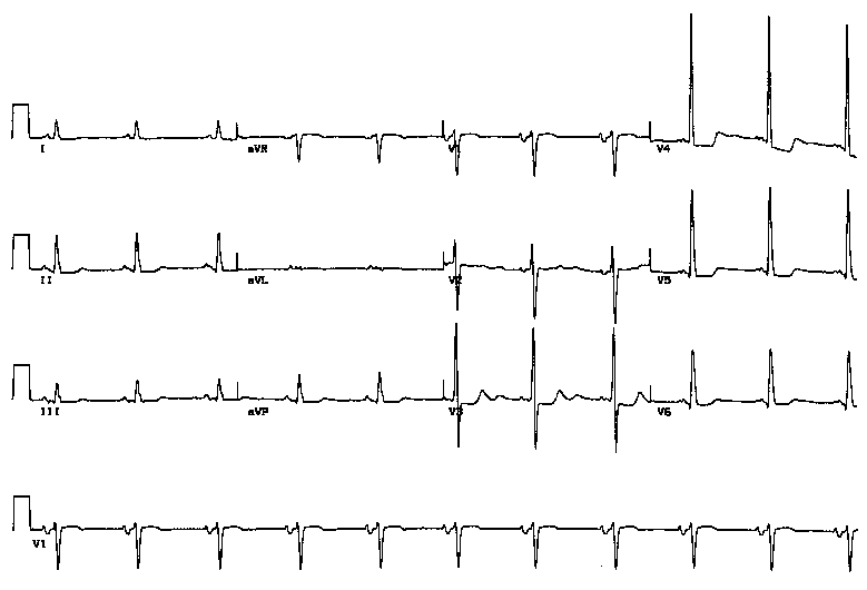 Atrial Ventricular