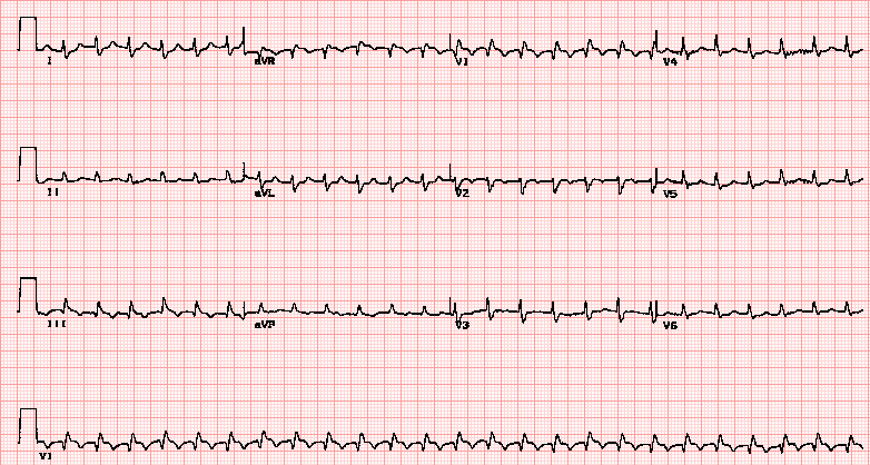 Acute pulmonary embolus